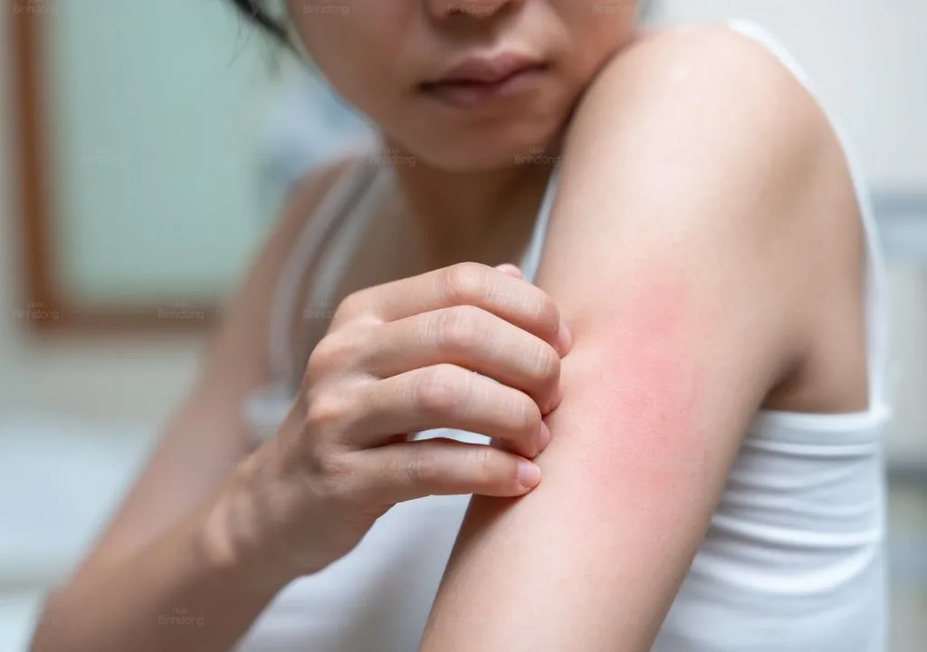 Picture for Nổi Mẫn Đỏ Ngứa: Nguyên Nhân, Triệu Chứng Và Cách Khắc Phục Hiệu Quả Cho Làn Da Khỏe Mạnh