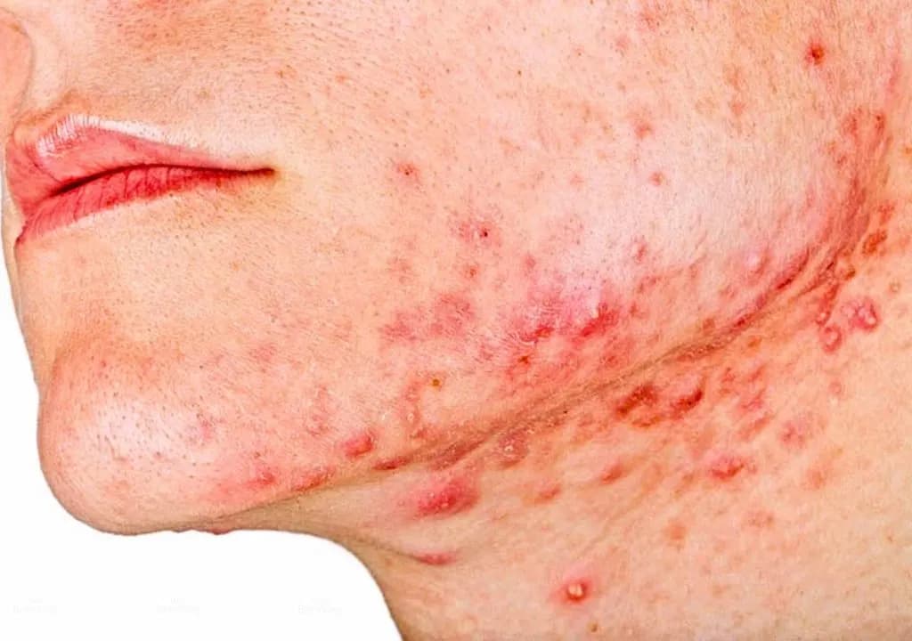 Picture for Nóng Trong Người Nổi Mụn: Nguyên Nhân, Triệu Chứng và Cách Khắc Phục Hiệu Quả